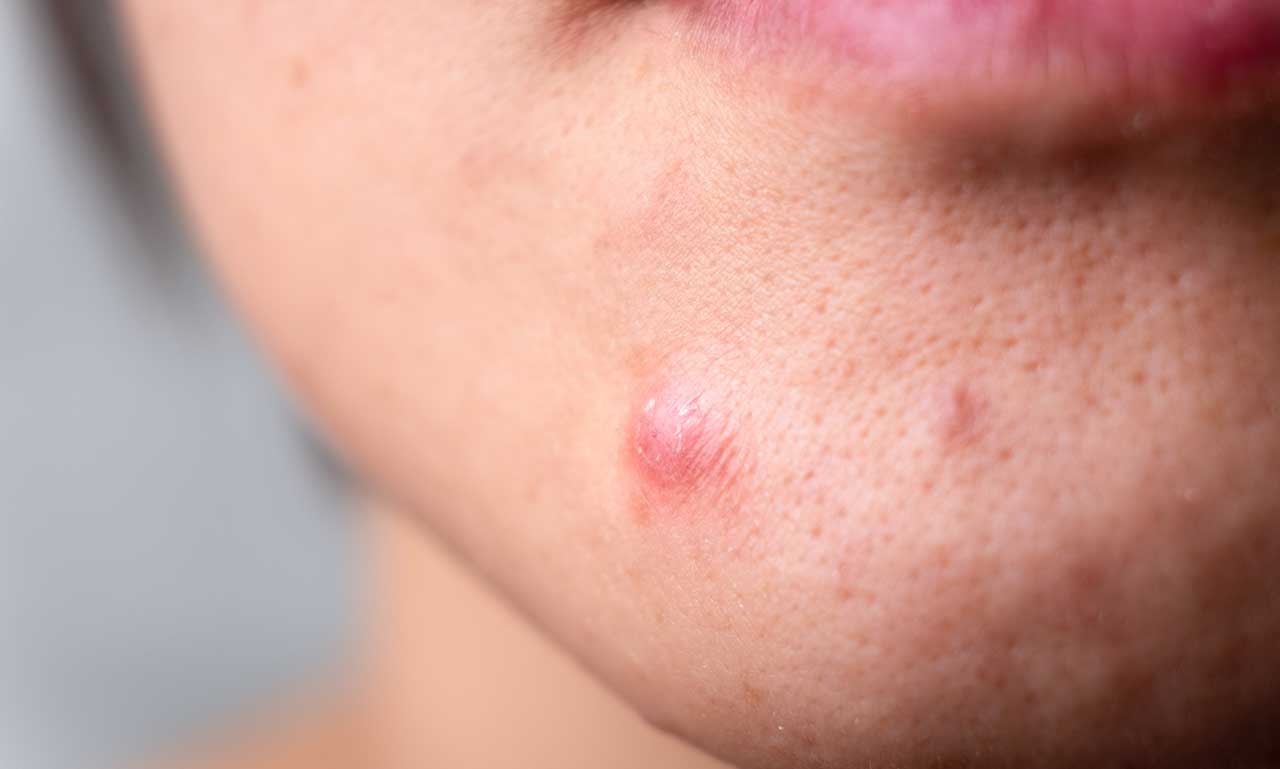 Doctor-led acne treatment consultation at The Women’s Health Clinic