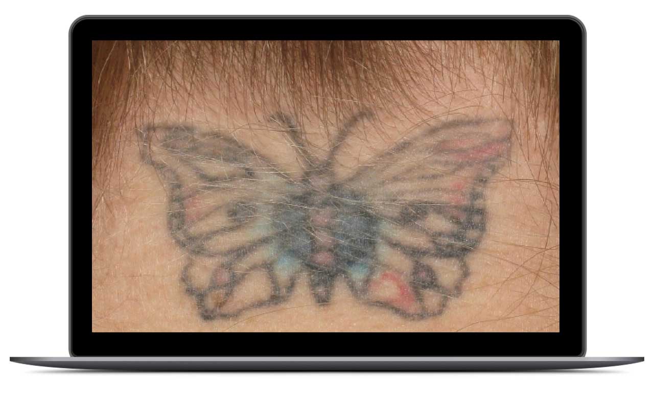 silvery-blue-womens-health-clinic-co2-tattoo-before-frame