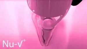 Vaginal rejuvenation 10 silvery blue womens health clinic vaginal rejuvenation laser 1