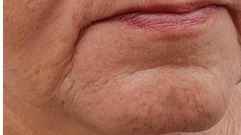 Doctor-led lower face lines and folds consultation at The Women’s Health Clinic