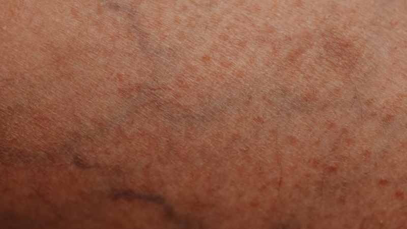 Doctor-led thread veins consultation at The Women’s Health Clinic